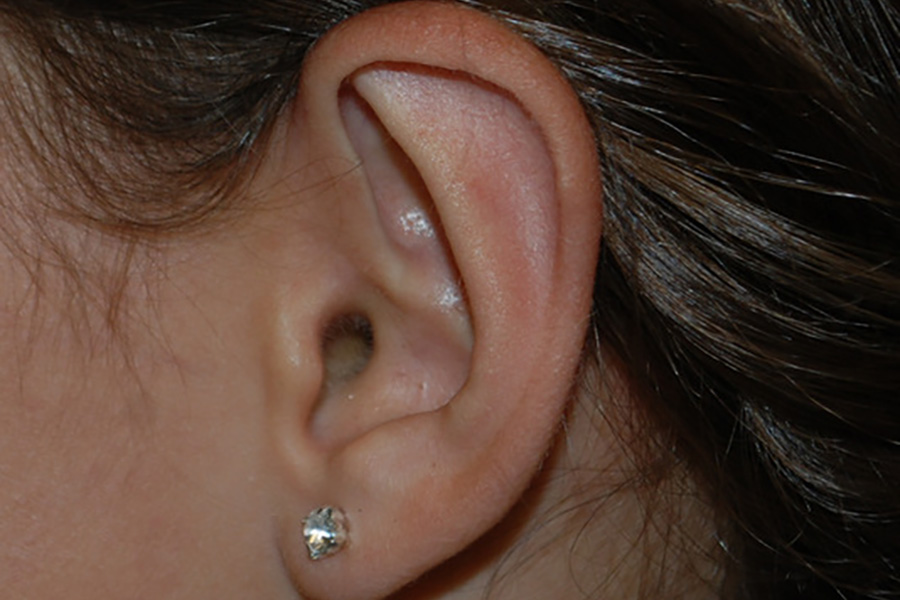 Prominent-Ear-Surgery-04 | After Prominent Ear Surgery 3