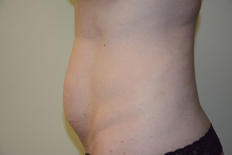 Tummy-Tuck-05 | Before Tummy Tuck 3