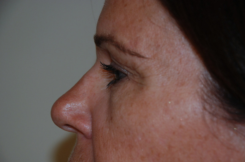 Eyelid-Surgery-04 | Before Eyelid Surgery 3