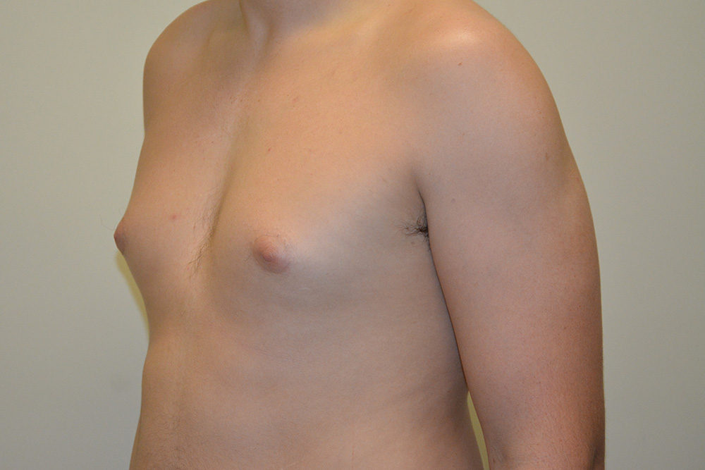 Male-Breast-Reduction-04 | Before Male Breast Reduction 4
