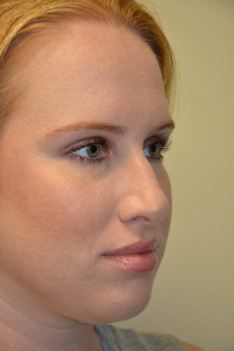 Rhinoplasty-04 | Before Rhinoplasty 4