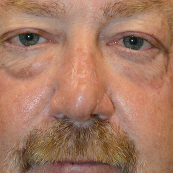 Skin-Cancer-Reconstruction-04 | After Skin Cancer Reconstruction