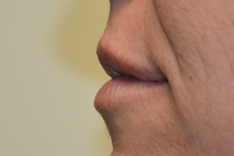 Injectable-Fillers-04 | After Injectable Fillers 2
