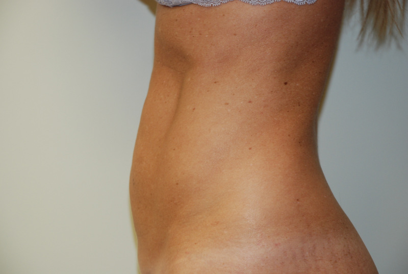 Mini-Tummy-Tuck-04 | Before Mini Tummy Tuck 5
