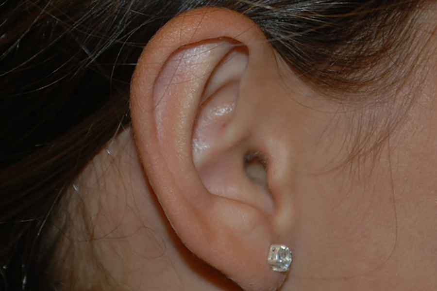 Prominent-Ear-Surgery-04 | After Prominent Ear Surgery 4