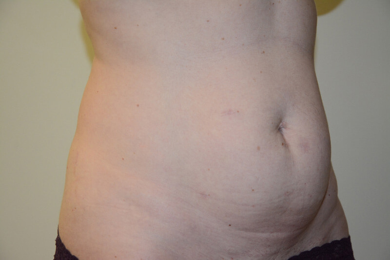 Tummy-Tuck-05 | Before Tummy Tuck 4