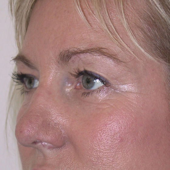 Brow-Lift-04 | After Brow Lift 2