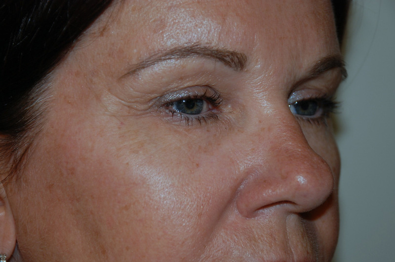 Eyelid-Surgery-04 | Before Eyelid Surgery 4