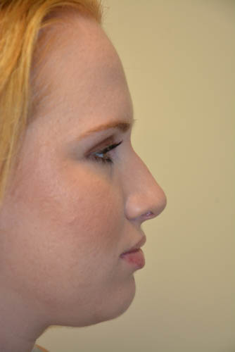 Rhinoplasty-04 | Before Rhinoplasty 5