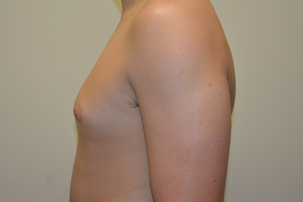 Male-Breast-Reduction-04 | Before Male Breast Reduction 5