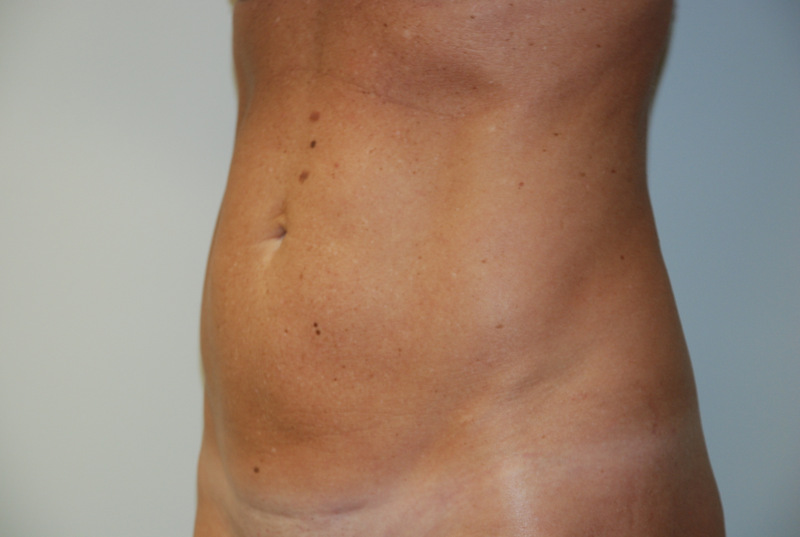 Mini-Tummy-Tuck-04 | Before Mini Tummy Tuck 4
