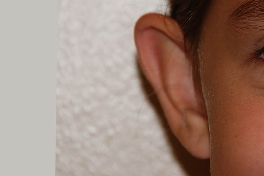 Prominent-Ear-Surgery-04 | Before Prominent Ear Surgery