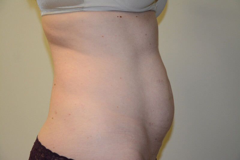 Tummy-Tuck-05 | Before Tummy Tuck 5