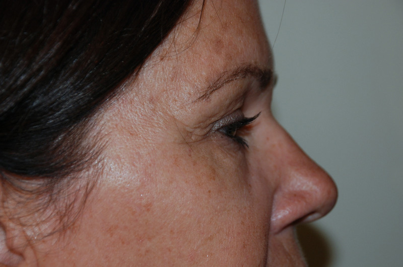 Eyelid-Surgery-04 | Before Eyelid Surgery 5