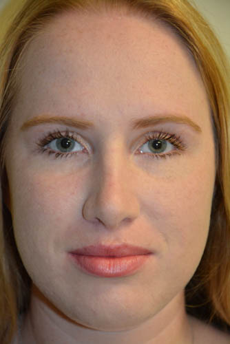 Rhinoplasty-04 | After Rhinoplasty