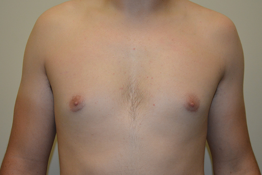 Male-Breast-Reduction-04 | After Male Breast Reduction