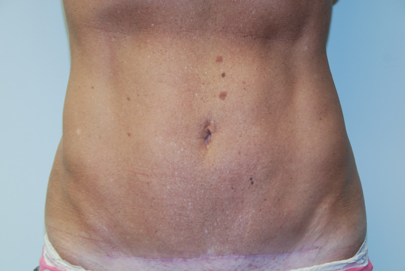 Mini-Tummy-Tuck-04 | After Mini Tummy Tuck 1