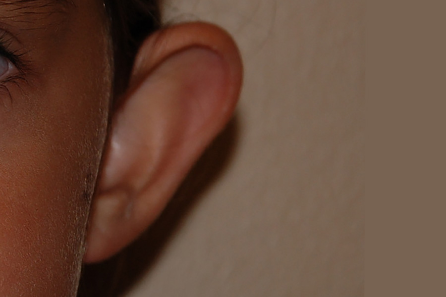 Prominent-Ear-Surgery-04 | Before Prominent Ear Surgery 2