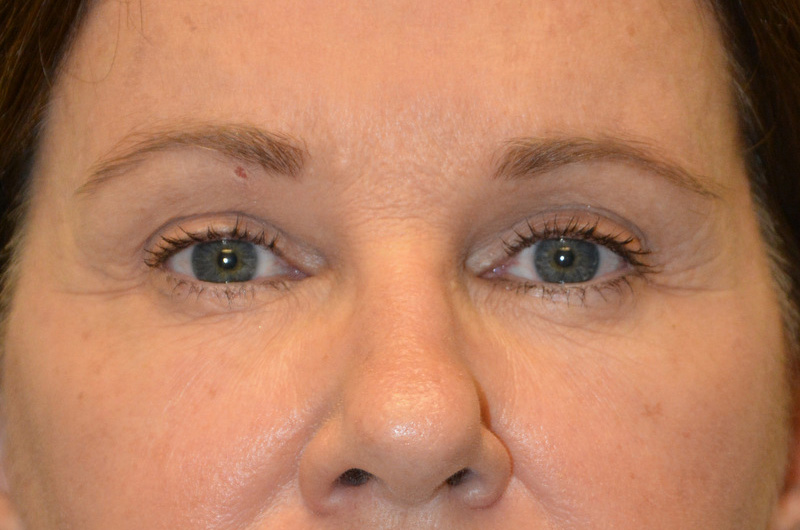 Eyelid-Surgery-04 | After Eyelid Surgery 1