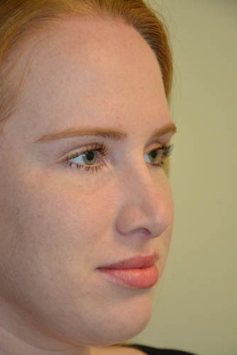 Rhinoplasty-04 | After Rhinoplasty 4