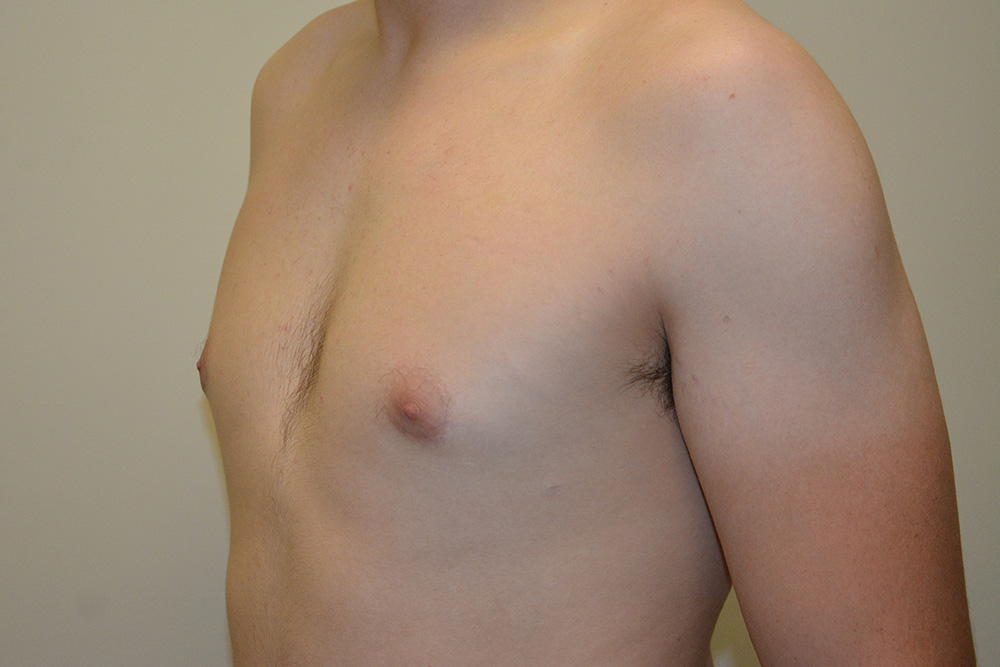 Male-Breast-Reduction-04 | After Male Breast Reduction 4