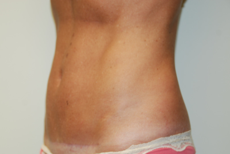 Mini-Tummy-Tuck-04 | After Mini Tummy Tuck 4