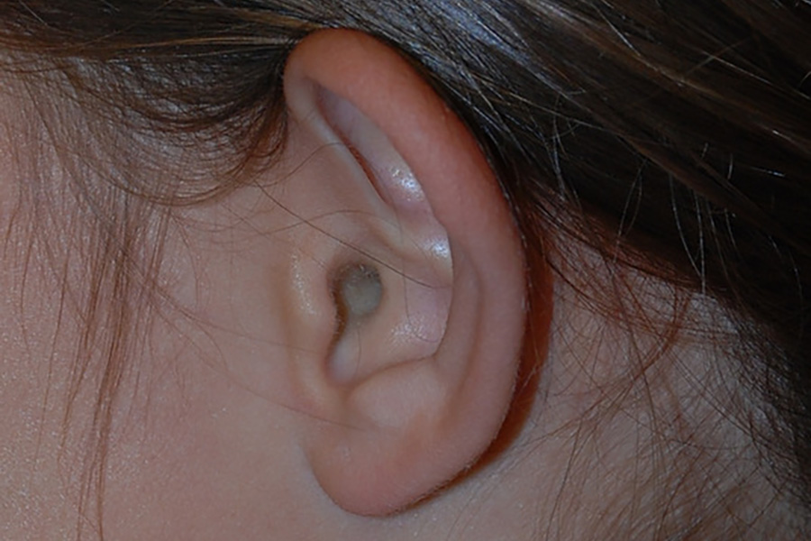Prominent-Ear-Surgery-04 | Before Prominent Ear Surgery 3