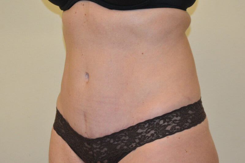 Tummy-Tuck-05 | After Tummy Tuck 2