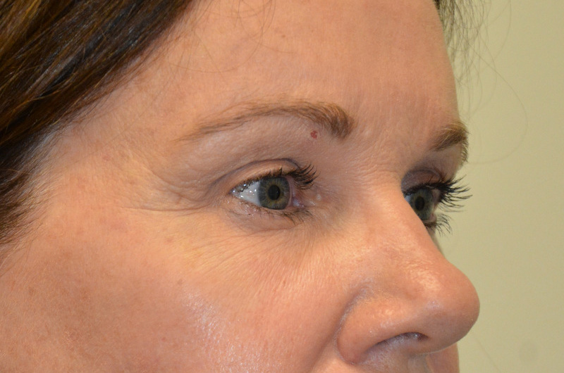 Eyelid-Surgery-04 | After Eyelid Surgery 4