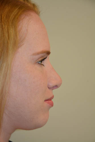 Rhinoplasty-04 | After Rhinoplasty 5