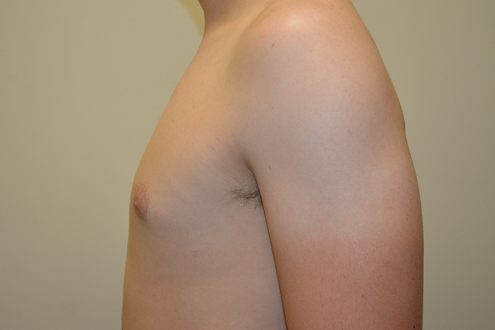 Male-Breast-Reduction-04 | After Male Breast Reduction 5