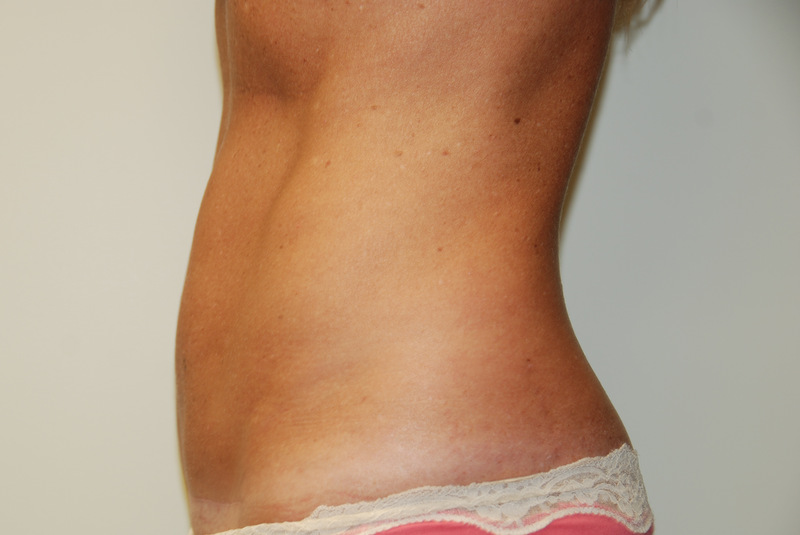 Mini-Tummy-Tuck-04 | After Mini Tummy Tuck 5