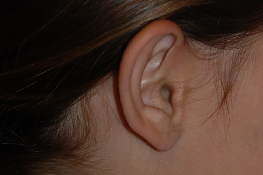 Prominent-Ear-Surgery-04 | Before Prominent Ear Surgery 4