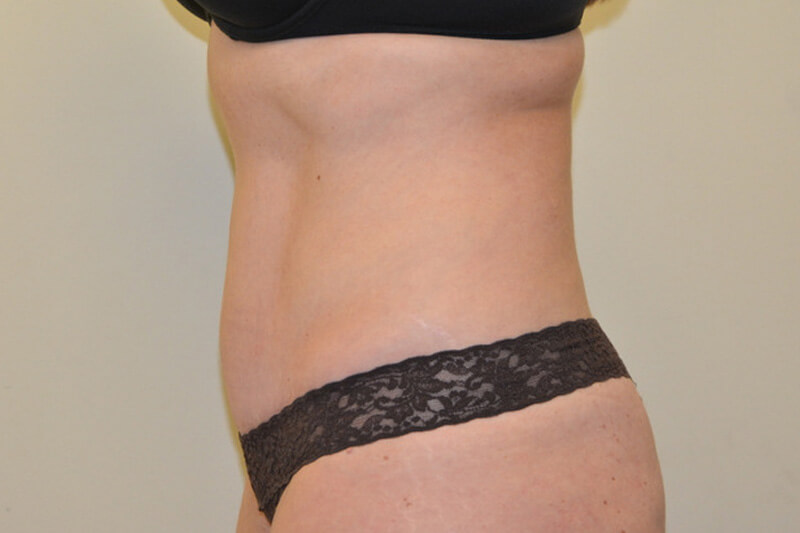 Tummy-Tuck-05 | After Tummy Tuck 3