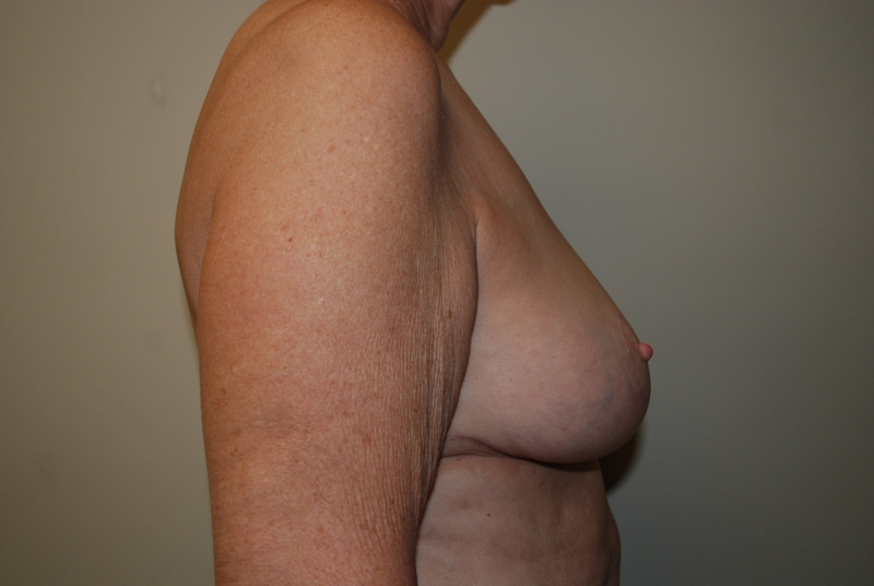Breast-Reduction-04 | After Breast Reduction 3