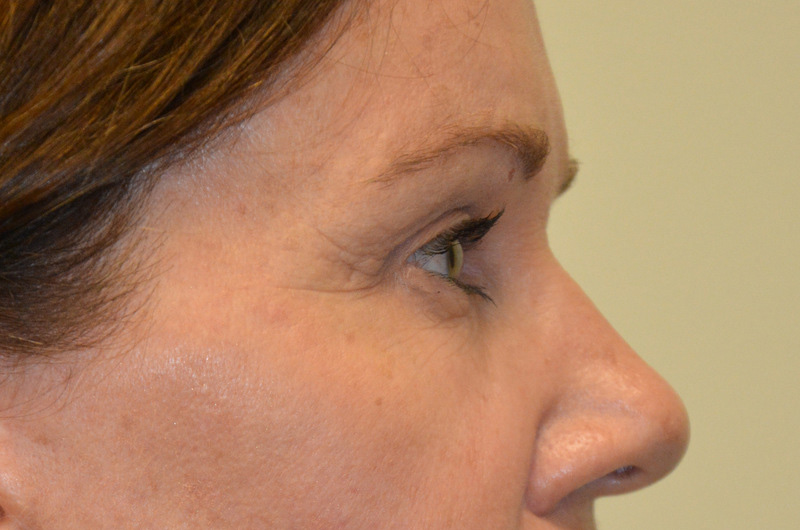 Eyelid-Surgery-04 | After Eyelid Surgery 5