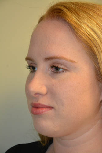 Rhinoplasty-04 | After Rhinoplasty 2