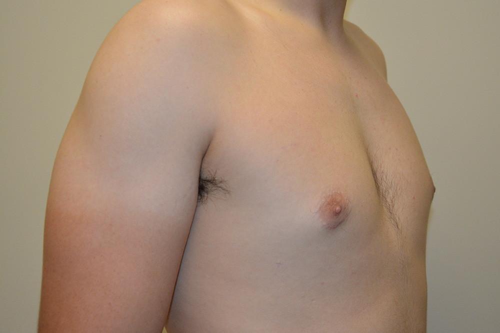 Male-Breast-Reduction-04 | After Male Breast Reduction 2