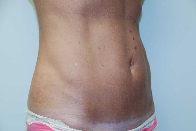 Mini-Tummy-Tuck-04 | After Mini Tummy Tuck 2