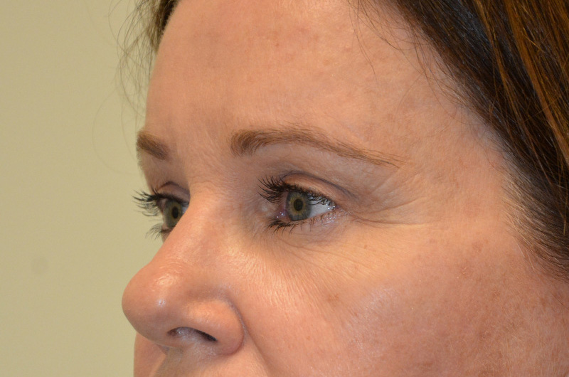 Eyelid-Surgery-04 | After Eyelid Surgery 2