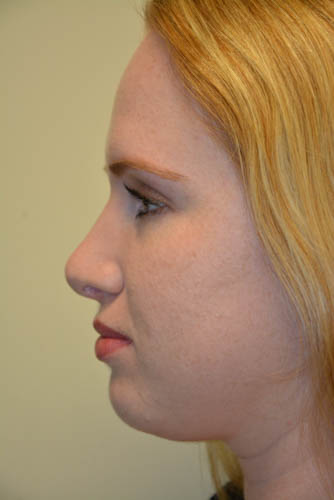 Rhinoplasty-04 | After Rhinoplasty 3