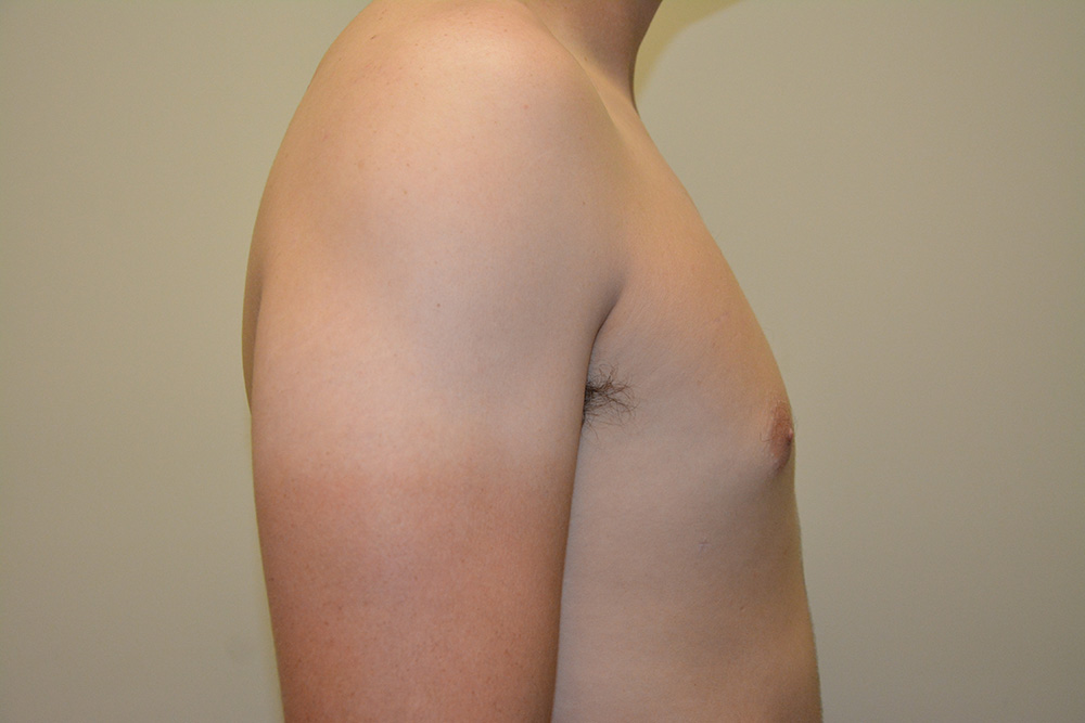 Male-Breast-Reduction-04 | After Male Breast Reduction 3
