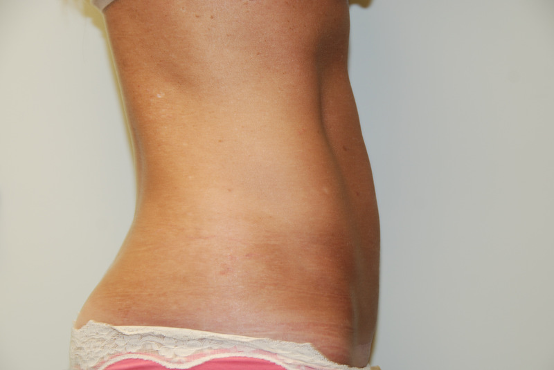 Mini-Tummy-Tuck-04 | After Mini Tummy Tuck 3
