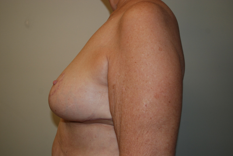 Breast-Reduction-04 | After Breast Reduction 5