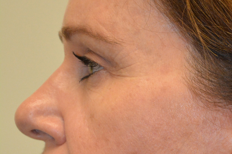 Eyelid-Surgery-04 | After Eyelid Surgery 3