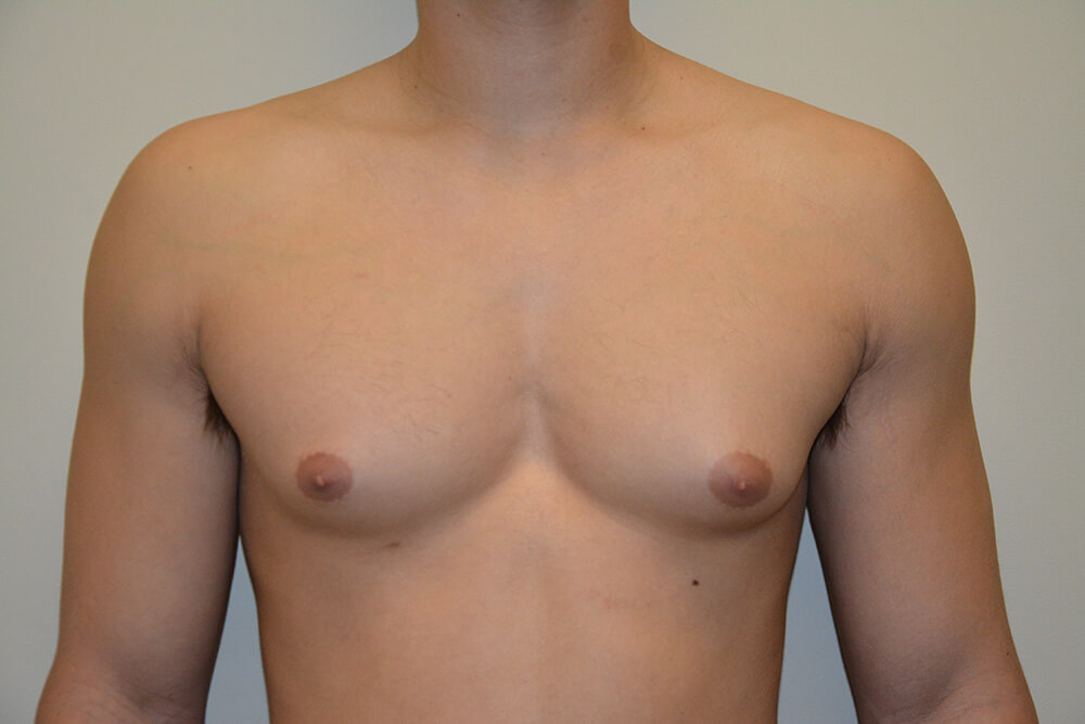 Male-Breast-Reduction-05 | Before Male Breast Reduction