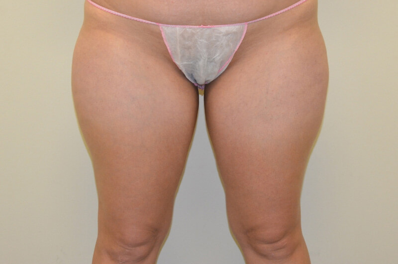 Liposuction-04 | Before Liposuction