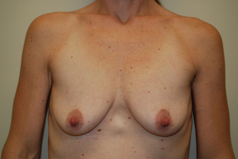 Breast-Lift-and-Augmentation-06 | Before Breast Lift and Augmentation