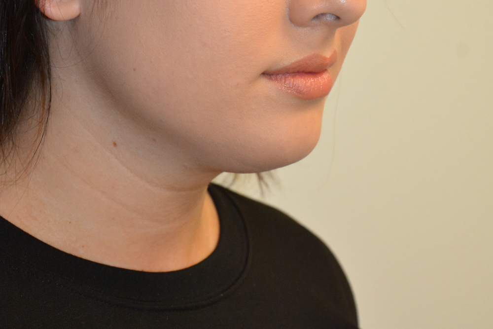 Neck-Liposuction-05 | Before Neck Liposuction 2