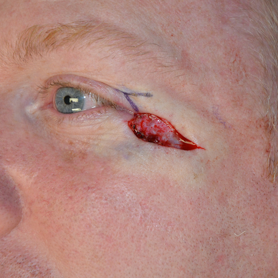 Skin-Cancer-Reconstruction-05 | Before Skin Cancer Reconstruction